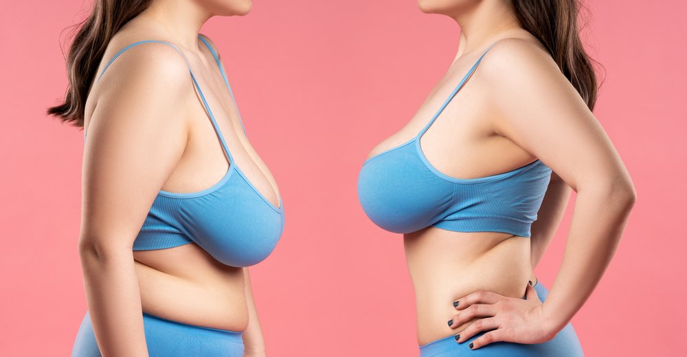 Breast Reduction