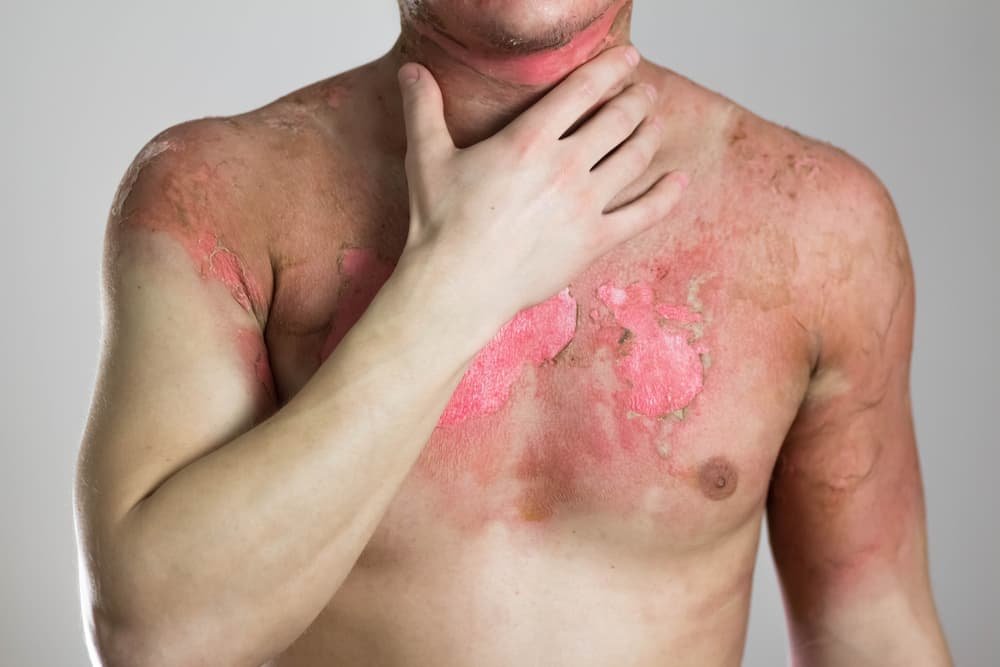 Disorders Caused by Burns
