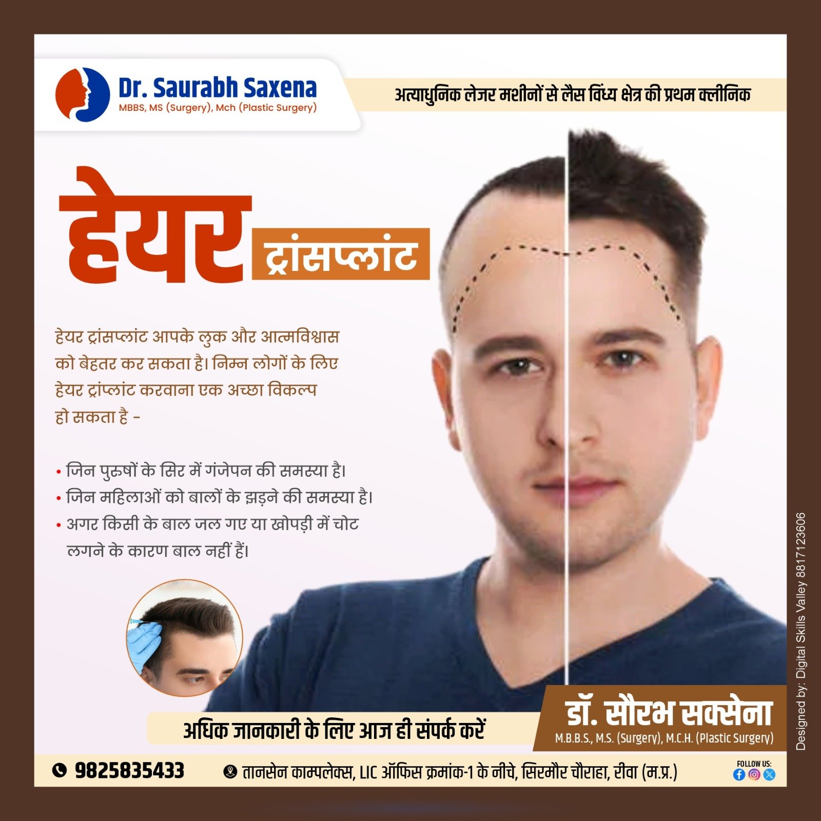 hair transplant